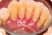 歯周治療 初期治療イメージ