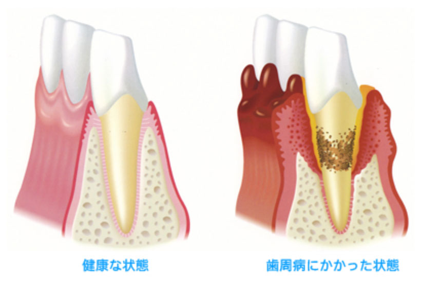 歯周病イメージ